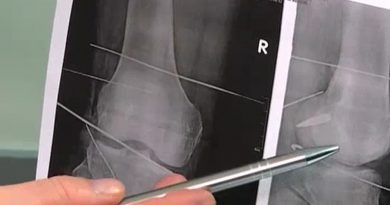 В Кишиневе хирурги спасли жизнь гражданину Азербайджана. Он получил пулевое ранение в ногу во время военных действий в Киеве