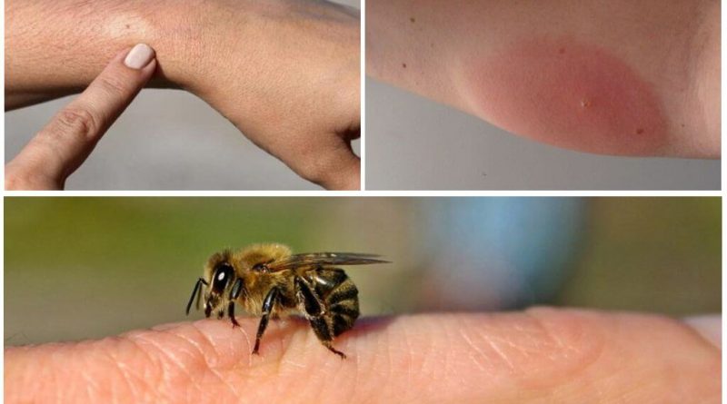 Врачи Молдовы предупреждают: число серьезных аллергических реакций на укусы насекомых растет
